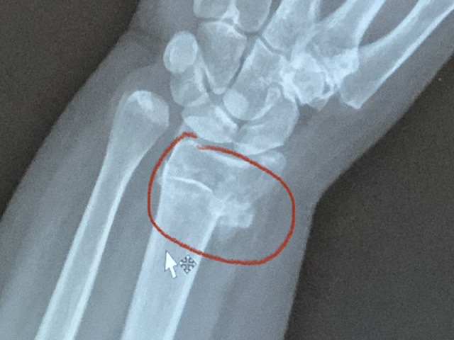 The Wrist Bone’s Connected to The Thumb Bone
